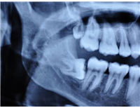 Röntgen(CT/3D Tomografi)